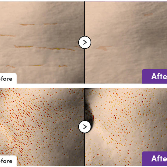 Before and after comparison of skin treatment on a person's face.